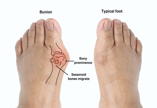 Closeup inflammation of deform bunion joint in big toe bone. Hallux valgus, bunion in female foot compare with typical foot isolated on white background.