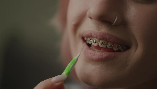 Dental Braces Cleaning Process. Woman brushing her teeth with braces with special brush, close up.