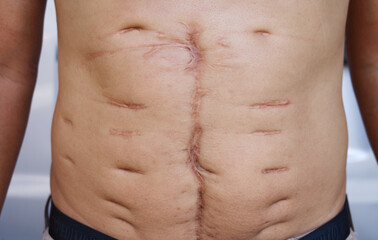 A large scar on the skin of an Asian man's abdomen was caused by major surgery, The longitudinal...