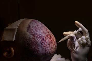 Hair transplantation. Macrophotography of a hair bulb transplanted into a hairless area. Baldness...