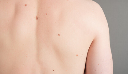 Young man from back with moles close-up on a gray background. Skin Cancer Awareness Month
