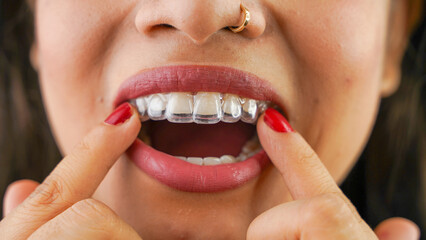 Young Asian Indian woman holding removable invisible aligner, also known as invisalign or  clear...
