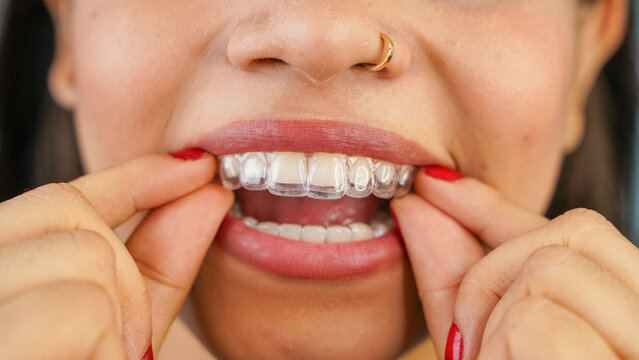 Young Asian Indian woman holding removable invisible aligner, also known as invisalign or  clear aligner