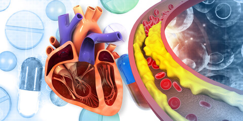 Cholesterol plaque in artery with Human heart anatomy. 3d illustration.