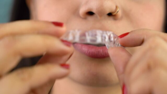 Young Asian Indian woman holding removable invisible aligner, also known as invisalign or  clear aligner