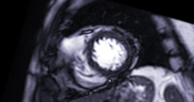 MRI heart or Cardiac MRI ( magnetic resonance imaging ) of heart  showing heart beating for detecting heart disease.
