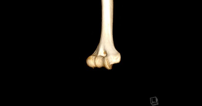 CT scan of Elbow joint 3D rendering image turn around on the screen .
