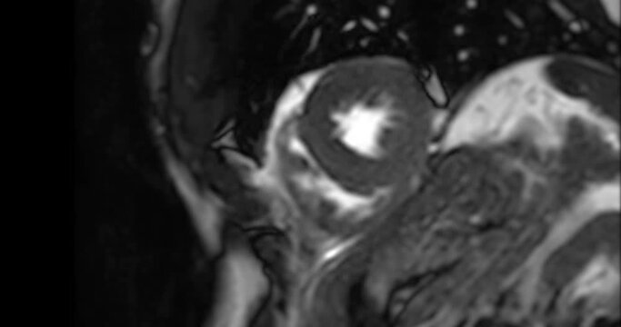 MRI heart or Cardiac MRI ( magnetic resonance imaging ) of heart  showing heart beating for detecting heart disease.
