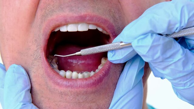 dental prosthetist examines oral cavity patient, charismatic mature man 60 years old open mouth, shows teeth with temporary fillings and metal, titanium pins for prosthetics or splinting, prosthetics