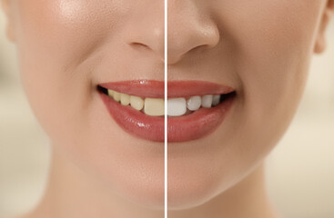 Photo of woman divided in halves before and after tooth whitening, closeup. Collage design