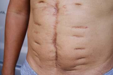Naklejka premium A large scar on the skin of an Asian man's abdomen was caused by major surgery, The longitudinal convex scar is a scratch from the stitches, The body suffered a large wound from hospital treatment.