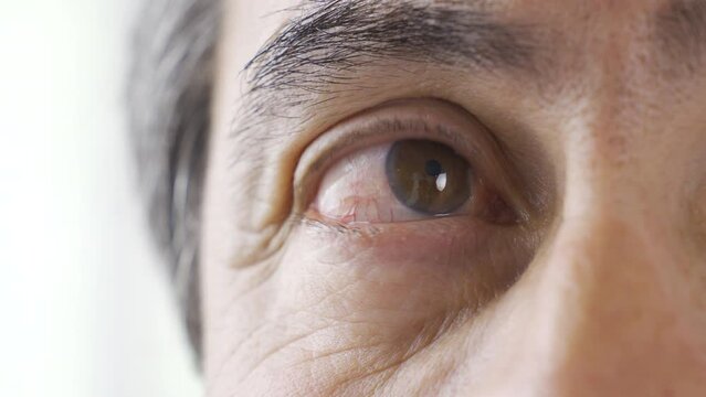 Flesh in the eye (pterygium).