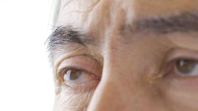 Eye disease (pterygium).