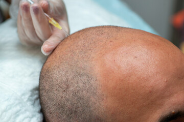 Hair transplantation and PRP application. PRP application to strengthen the hair follicle.