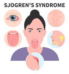 Sjogren's Syndrome dry eye Lymph nodes redness saliva sialadenitis Intraoral halitosis Burning Fissured Difficulty swallowing Fissured throat skin Cracked sore tongue - obrazy, fototapety, plakaty