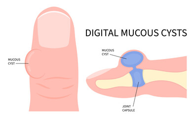 Digital Mucous Myxoid Cyst and Needling drain osteoarthritis ganglion synovial finger joint disease biopsy medical - obrazy, fototapety, plakaty