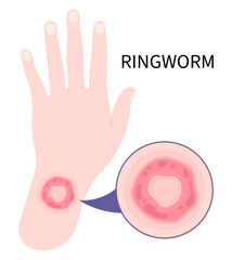 Skin rash cause jock itch fungal dermatophytosis and psoriasis ringworm eczema or body fungus tinea cruris Itchiness Scaly athlete's circular excessive infection in leg