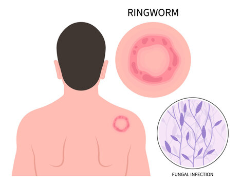 body skin fungal rash in hand with ringworm eczema psoriasis or Jock itch leg fungus tinea cruris dermatophytosis Itchiness Scaly athlete's circular excessive infection