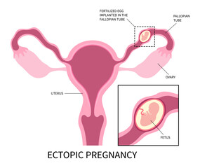 Ectopic pregnancy abortion miscarriage blighted ovum fallopian tube and In vitro Fertilisation ovaries womb fertilized