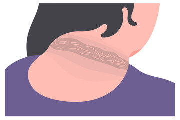 Acanthosis nigricans Dark patches skin elbows thick velvety texture prediabetes characterize diabetes