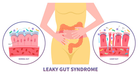 intestinal bacterial overgrowth leaky gut syndrome celiac disease pain of food immune Inflammatory system upper tract Small gluten psoriasis with IBS and IBD Irritable bowel medical peptic ulcer - obrazy, fototapety, plakaty