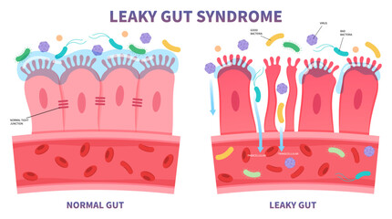 leaky gut syndrome celiac disease pain of food immune with IBS and IBD Irritable bowel Inflammatory system upper tract peptic ulcer Small intestinal bacterial overgrowth gluten psoriasis medical - obrazy, fototapety, plakaty