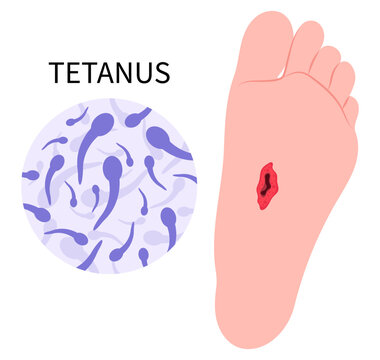 Tetanus infection bacteria Clostridium tetani virus bacterial toxin lockjaw Vaccination and vaccine prevention Stepped on a Nail trauma