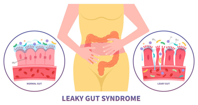 intestinal bacterial overgrowth leaky gut syndrome celiac disease pain of food immune Inflammatory system upper tract Small gluten psoriasis with IBS and IBD Irritable bowel medical peptic ulcer