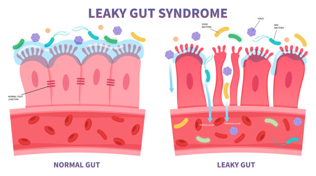 leaky gut syndrome celiac disease pain of food immune with IBS and IBD Irritable bowel Inflammatory system upper tract peptic ulcer Small intestinal bacterial overgrowth gluten psoriasis medical