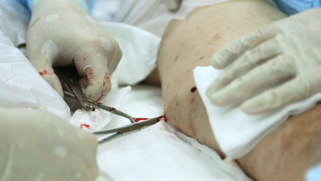 Phlebologist surgeon uses metal medical clamp scissors to pull out a varicose vein. Removal of the damaged vein through a small hole in the leg