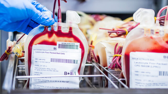 Leukocyte poor pack red cell in transfusion bag on a tray inside blood bank.Label as B Rh plus.Rare blood group prepares for donation or therapy of anemia patient in hospital.Many plastic bags.