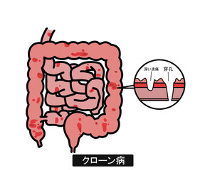 クローン病