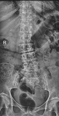 X-Ray of The Lumber sacral spine AP image