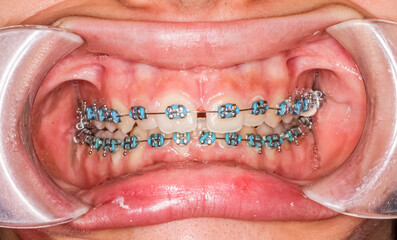 Dental orthodontic braces with blue colored elastic ligatures. Orthodontics teeth alignment...