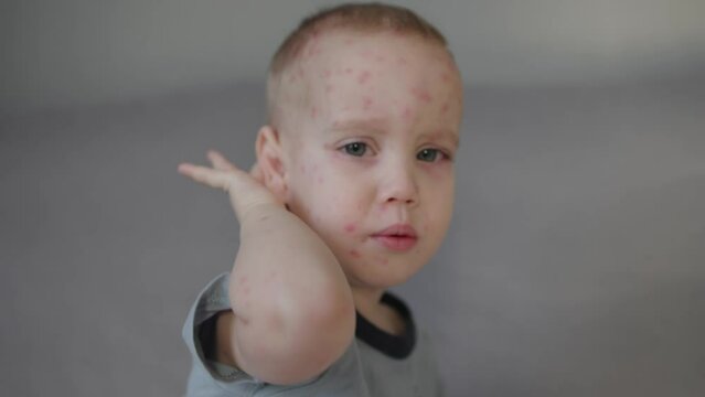 baby child little kid chicken pox disease face red pimples symptoms boy suffer from itch try to scratch skin with hand, crying capricious emotions. varicella sickness rash fluid-filled blisters scab