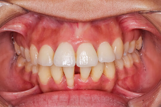 Front view of dental arches in occlusion, lips and cheeks retracted with cheek retractor. Healthy teeth with diastema gap between lower central incisors and periodontal disease gingiva gum recession.