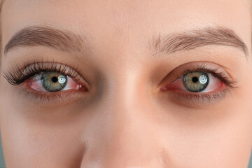 Woman with red eyes suffering from conjunctivitis, closeup - obrazy, fototapety, plakaty