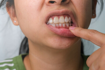 Asian woman holding her hand on her cheek feeling toothache, tooth decay, gingivitis or bad breath...