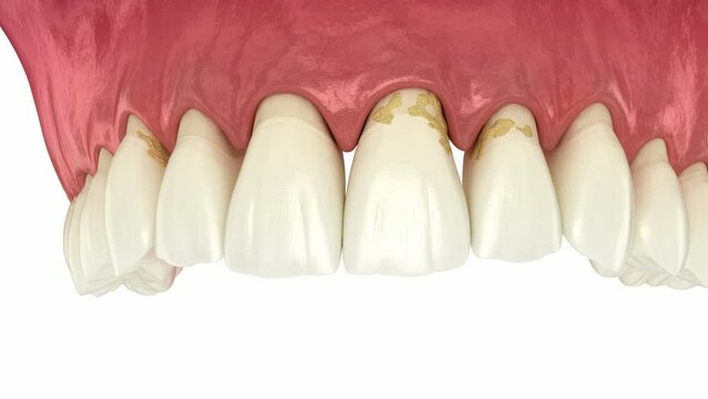 Periodontitis and gum recession in dynamics, teeth losing. Dental 3D animation