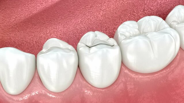 Inlay ceramic crown placement. Medically accurate 3D animation