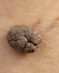 large mole on the skin as a background.