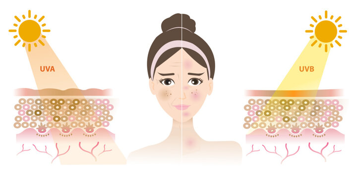 Comparison of damaged skin face from UVA and UVB rays vector on white background. Resulting in a tan, melasma, aging, wrinkle, dark spots, burn, inflammation and red spots. 