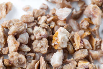 Kidney stones. Stones were removed from the patient's kidneys