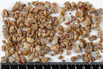 Kidney stones. Stones were removed from the patient's kidneys