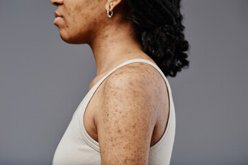 Closeup side view of black young woman with real skin texture and acne scars on shoulders and arms