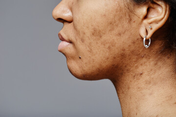 Closeup side view of black young woman with real skin texture and acne scars on face and neck, copy...