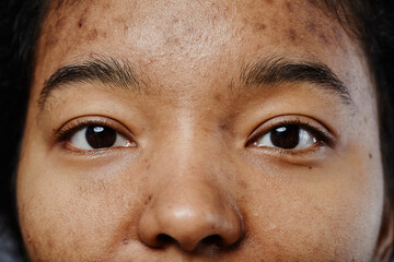 Closeup of black young woman with acne scars on face looking at camera