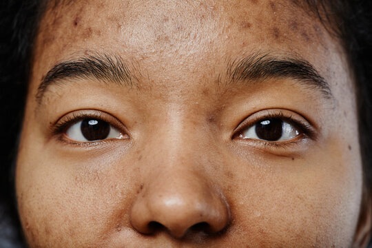 Closeup of black young woman with acne scars on face looking at camera