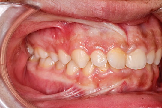 Dental maxillary and mandibular arches in occlusion with biting crooked anterior central incisors teeth. Oblique direct side view with cheek retractor, gingival gum frenulum.