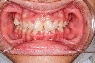 Dental maxillary and mandibular arches in occlusion with biting teeth, crooked upper incisal teeth, cheeks and lips retracted with cheek retractor. Healthy gingival gum and no decay.